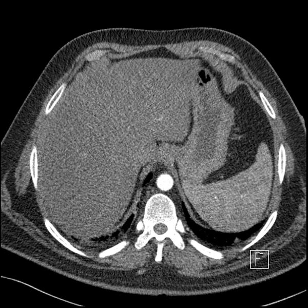 File:Acute pulmonary embolism with pulmonary infarct (Radiopaedia 73062-83768 Axial C+ CTPA 70).jpg