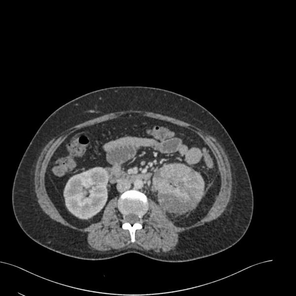 File:Acute pyelonephritis with renal vein thrombosis (Radiopaedia 58020-65053 Axial renal parenchymal phase 86).jpg