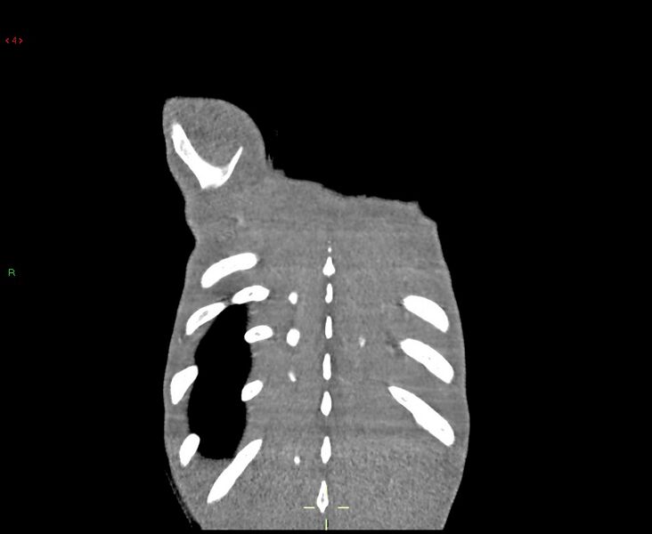 File:Acute right lung abscess (Radiopaedia 34806-36258 Coronal C+ arterial phase 1).jpg