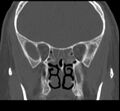 Acute sinusitis (Radiopaedia 23161-23215 Coronal bone window 42).jpg