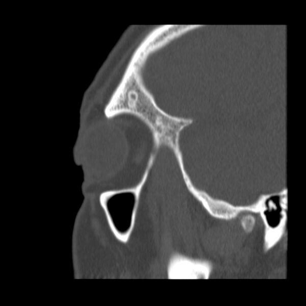 File:Acute sinusitis (Radiopaedia 23161-23215 Sagittal bone window 12).jpg