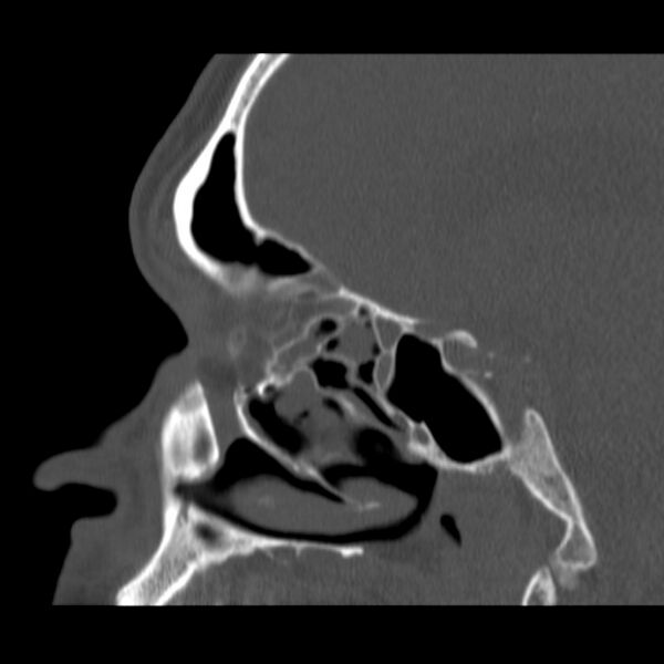 File:Acute sinusitis (Radiopaedia 23161-23215 Sagittal bone window 39).jpg