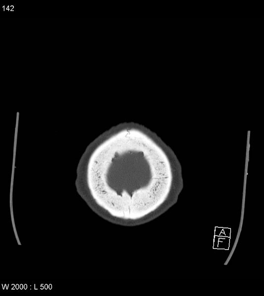 File:Acute subdural hematoma with myelofibrosis (Radiopaedia 52582-58494 Axial bone window 71).jpg