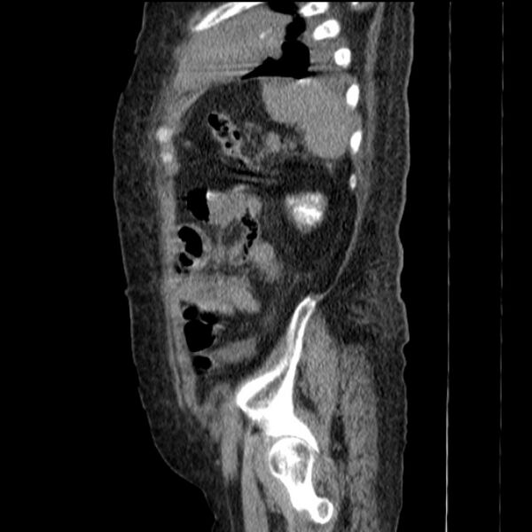 File:Acute tubular necrosis (Radiopaedia 28077-28334 H 71).jpg