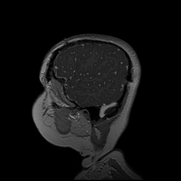 File:Adamantinomatous craniopharyngioma (Radiopaedia 77407-89529 H 104).jpg
