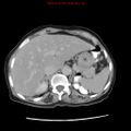 Adenocarcinoma of the colon (Radiopaedia 8191-9039 Axial renal excretory phase 4).jpg