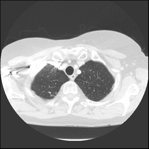 File:Adenocarcinoma of the lung (Radiopaedia 41015-43755 Axial lung window 17).jpg
