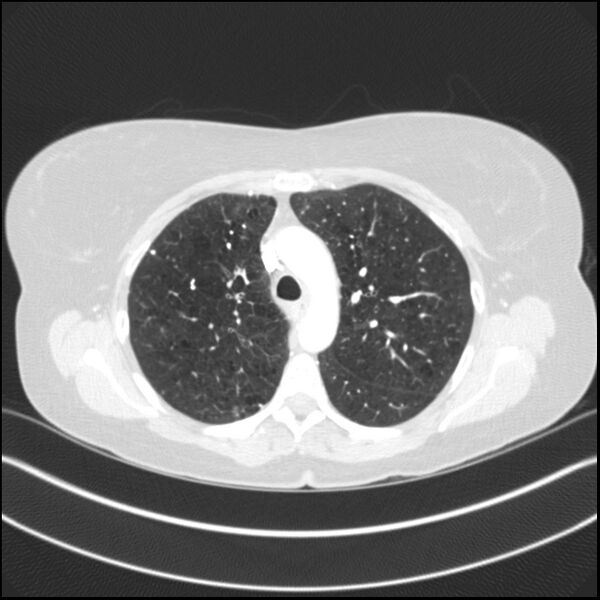File:Adenocarcinoma of the lung (Radiopaedia 44205-47803 Axial lung window 32).jpg