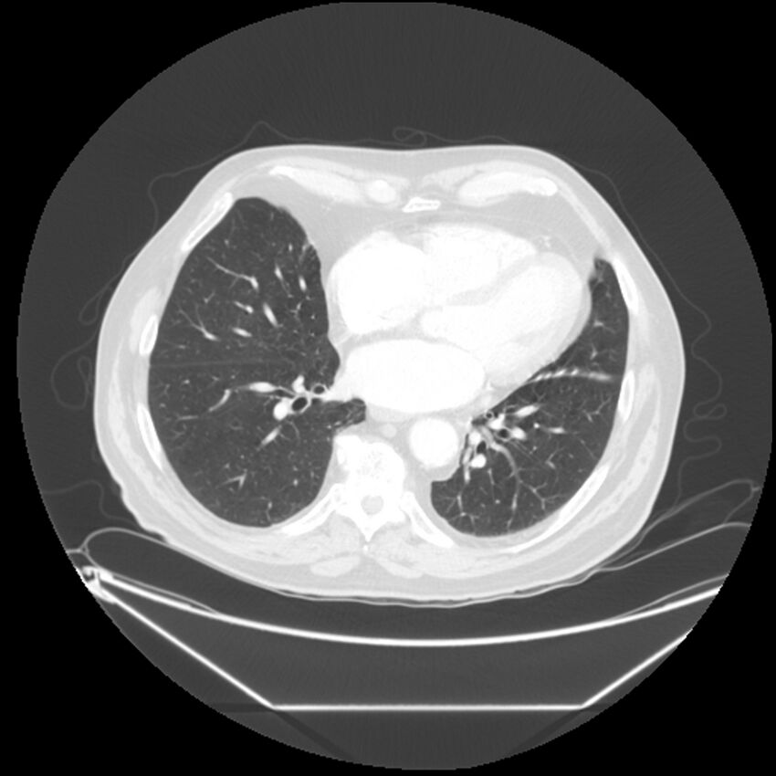 Adenocarcinoma of the lung (Radiopaedia 44876-48759 Axial lung window 51).jpg