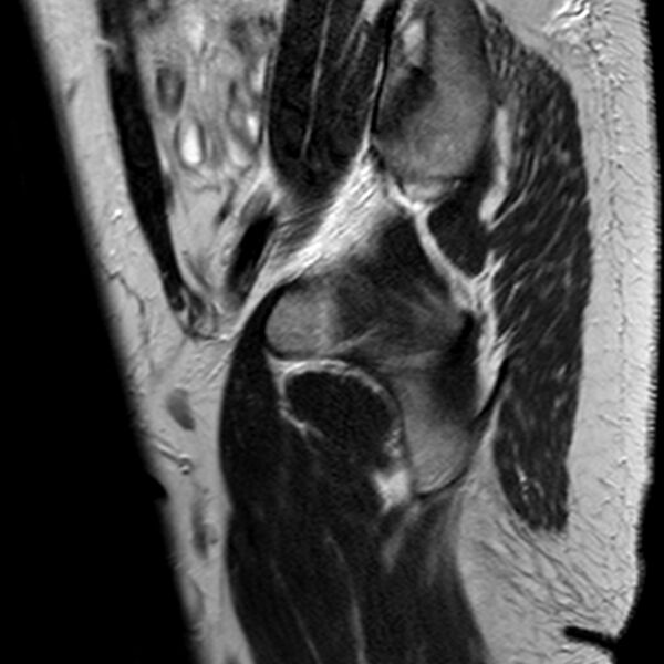 File:Adenomyoma of the uterus (Radiopaedia 9871-10439 Sagittal T2 25).jpg