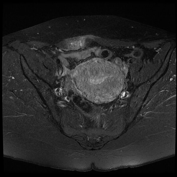 File:Adenomyosis-scar endometriosis (Radiopaedia 65863-75022 Axial T1 C+ fat sat 9).jpg
