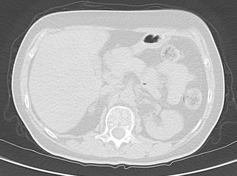 File:Adenosquamous lung carcinoma (Radiopaedia 22035-22030 lung window 64).jpg