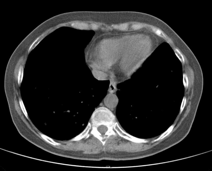 Adenosquamous lung carcinoma (Radiopaedia 22035-22030 non-contrast 45).jpg