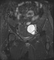 Adnexal multilocular cyst (O-RADS US 3- O-RADS MRI 3) (Radiopaedia 87426-103754 Coronal T2 fat sat 12).jpg