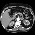 Adrenal hemangioma (Radiopaedia 11039-11445 Axial C+ arterial phase 8).jpg