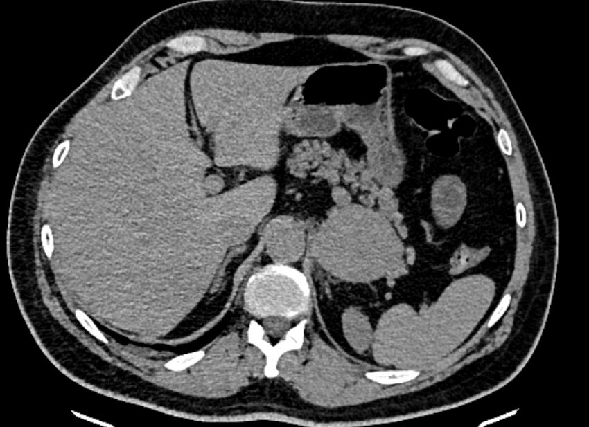 Adrenal metastases (Radiopaedia 73082-83791 Axial non-contrast 43).jpg