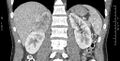 Adrenal pheochromocytoma (Radiopaedia 35133-36726 Coronal C+ portal venous phase 26).jpg