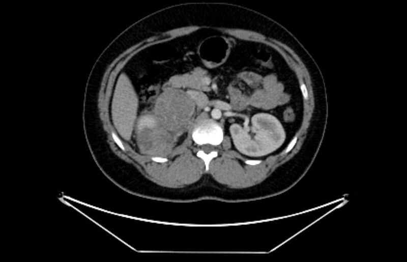 File:Adrenocortical carcinoma (Radiopaedia 80134-93438 Axial C+ portal venous phase 52).jpg