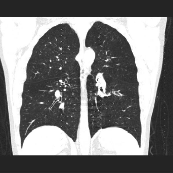 File:Allergic bronchopulmonary aspergillosis (Radiopaedia 21386-21320 Coronal lung window 11).jpg