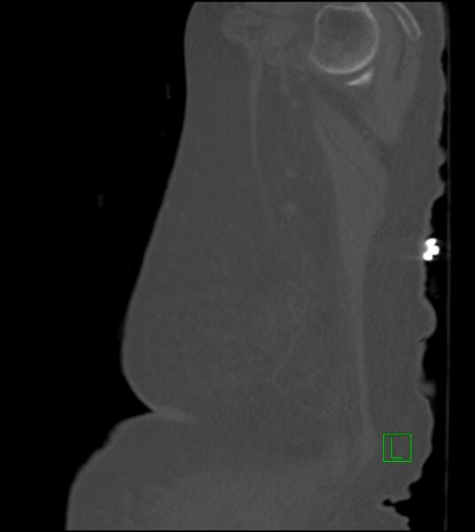 File:Amiodarone deposition in the liver (Radiopaedia 77587-89780 Sagittal bone window 10).jpg