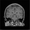 Amnestic syndrome secondary to hypoxic brain injury (Radiopaedia 24743-25004 B 11).jpg