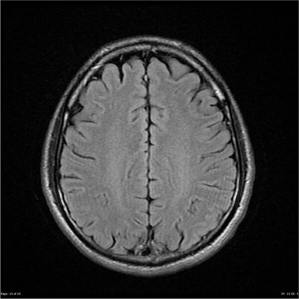 File:Amnestic syndrome secondary to hypoxic brain injury (Radiopaedia 24743-25004 FLAIR 15).jpg