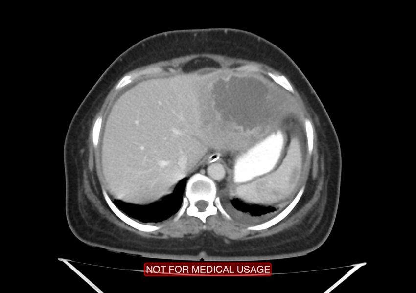 Amoebic enterocolitis with liver abscess (Radiopaedia 35100-36609 A 14).jpg