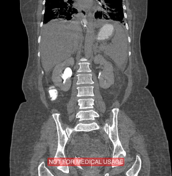 File:Amoebic enterocolitis with liver abscess (Radiopaedia 35100-36609 B 129).jpg