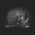 Ampullary tumor (Radiopaedia 27294-27479 T2 SPAIR 16).jpg