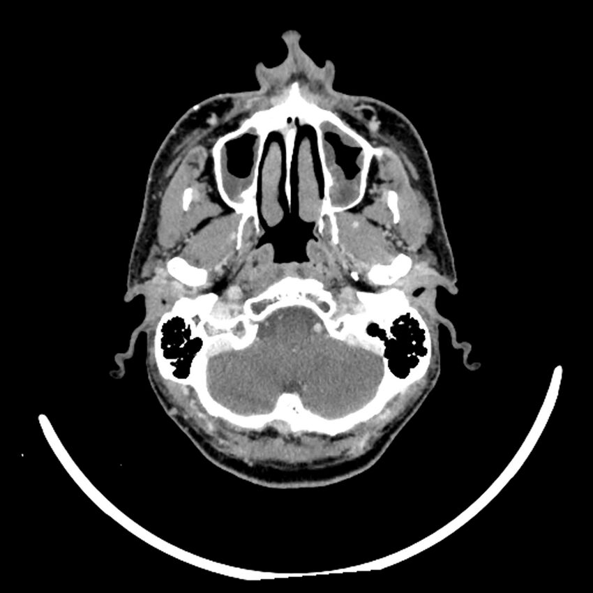 Anaplastic thyroid carcinoma (Radiopaedia 79087-92034 B 112).jpg