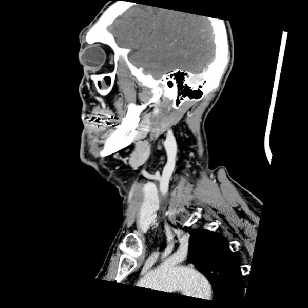 File:Anaplastic thyroid carcinoma (Radiopaedia 79087-92034 C 69).jpg