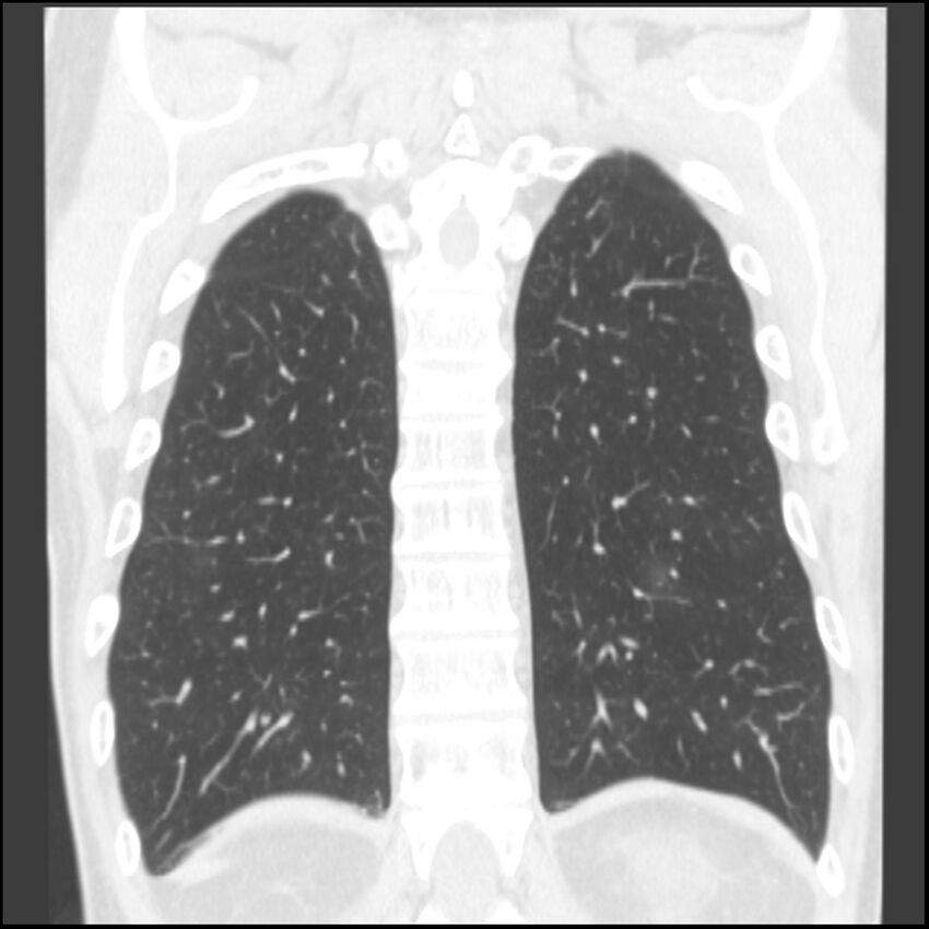 Angioinvasive aspergillosis (Radiopaedia 43957-47466 Coronal lung window 19).jpg