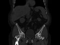 Ankylosing spondylitis (Radiopaedia 44609-48357 Coronal bone window 21).jpg