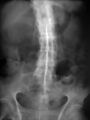 Ankylosing spondylitis with bamboo spine and dagger sign (Radiopaedia 21781).jpg