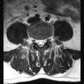 Ankylosing spondylitis with zygapophyseal arthritis (Radiopaedia 38433-40516 Axial T2 8).jpg