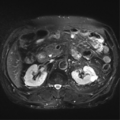 Annular pancreas (Radiopaedia 38292-40320 Axial T2 fat sat 15).png