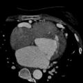 Anomalous left coronary artery from the pulmonary artery (ALCAPA) (Radiopaedia 40884-43586 A 37).jpg