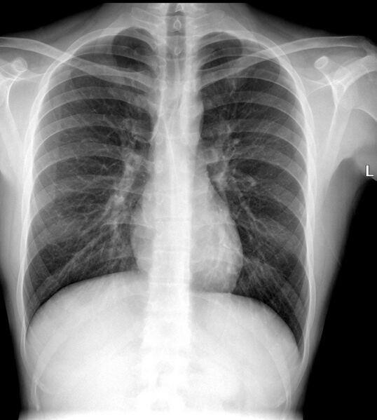 File:Anterior and posterior junctional lines (chest x-ray) (Radiopaedia 25419-25661 Frontal 1).JPG