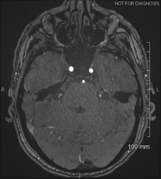 File:Anterior cerebral artery aneurysm (Radiopaedia 80683-94127 Axial MRA 69).jpg