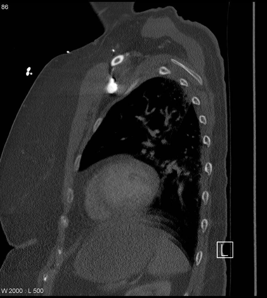 Anterior shoulder dislocation (CT) (Radiopaedia 59032-66309 Sagittal bone window 43).jpg