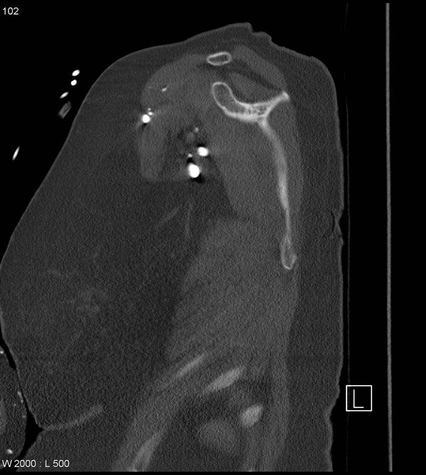 Anterior shoulder dislocation (CT) (Radiopaedia 59032-66309 Sagittal bone window 51).jpg