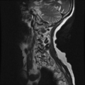 Anterior spinal artery syndrome (Radiopaedia 46335-50750 A 1).png