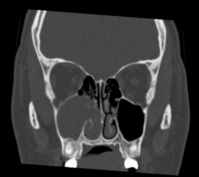 File:Antrochoanal polyp (Radiopaedia 21894-21868 Coronal bone window 15).jpg