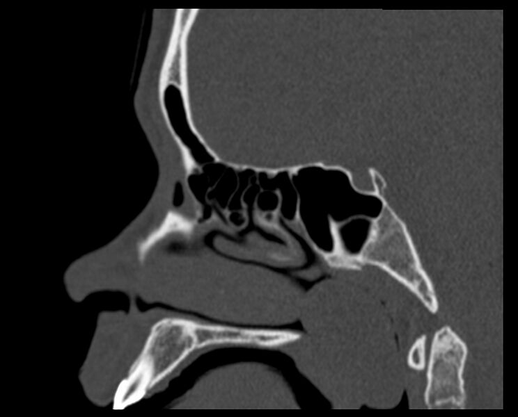 File:Antrochoanal polyp (Radiopaedia 21894-21868 Sagittal bone window 23).jpg