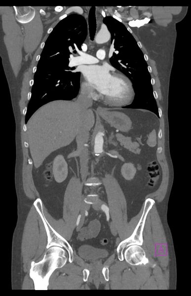File:Aortectomy and axillary-bifemoral bypass (Radiopaedia 28303-28545 C 48).jpg