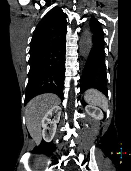File:Aortic aneurysm and penetrating ulcer (Radiopaedia 23590-23704 B 24).jpg