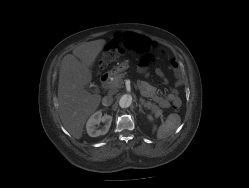File:Aortic dissection (Radiopaedia 28802-29105 A 49).jpg