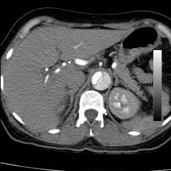 File:Aortic dissection - Stanford type A (Radiopaedia 29247-29659 A 78).jpg