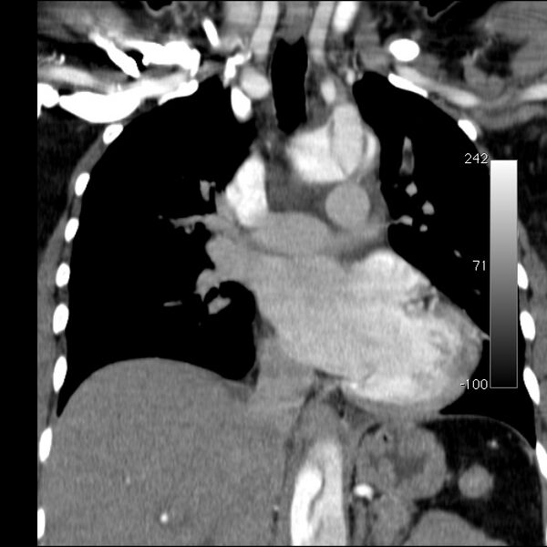 File:Aortic dissection - Stanford type A (Radiopaedia 29247-29659 B 31).jpg
