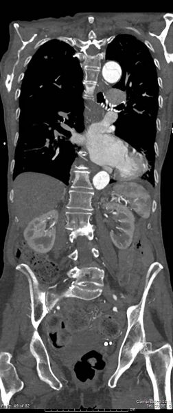 File:Aortic dissection with extension into aortic arch branches (Radiopaedia 64402-73204 A 49).jpg